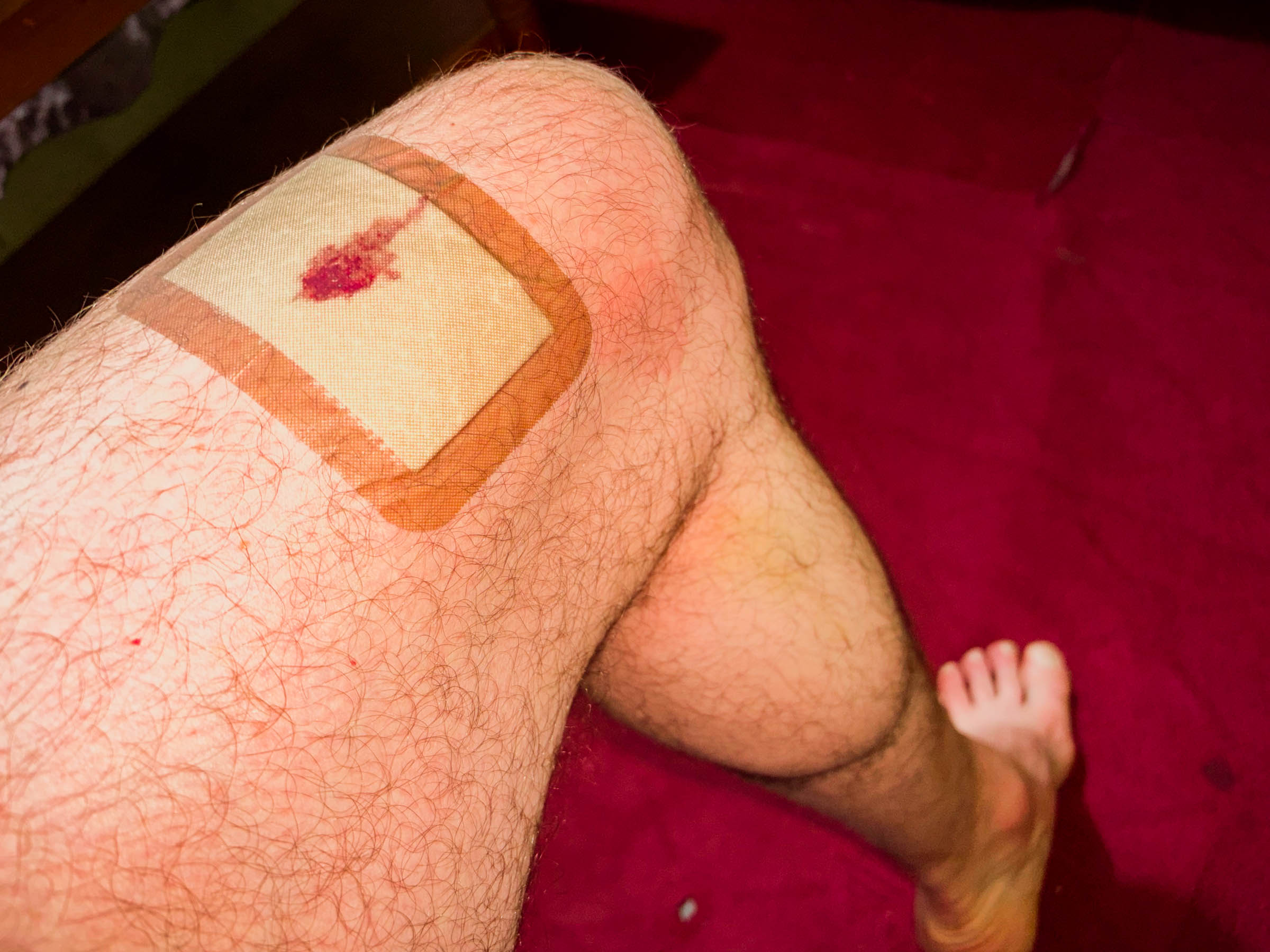 My thigh with a big bloody Band-Aid